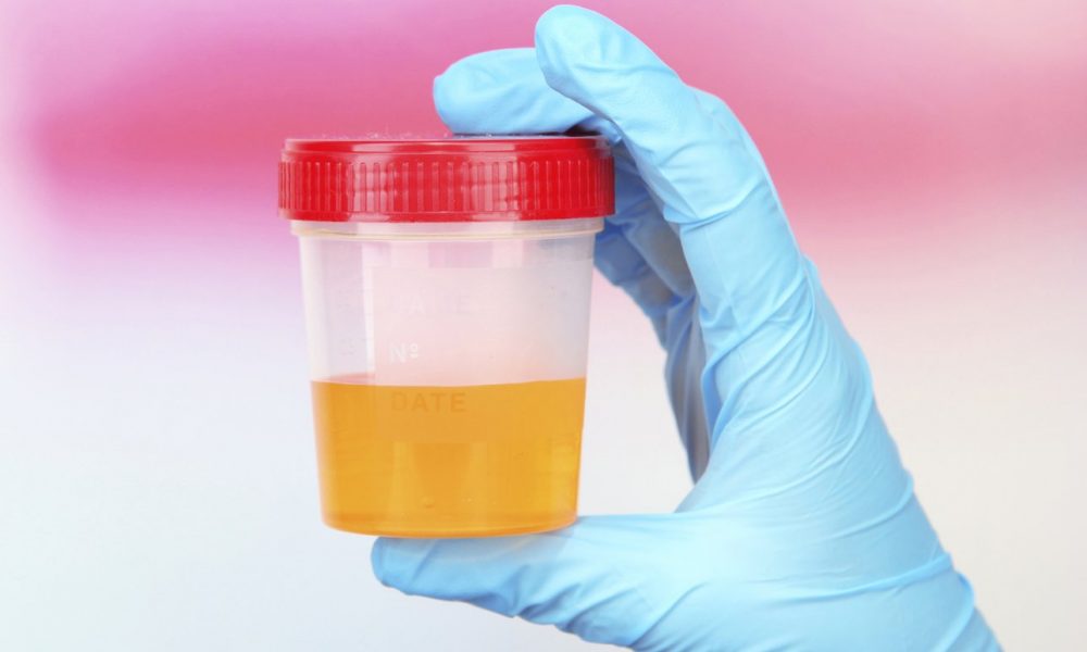 Различные виды и расшифровка анализов мочи