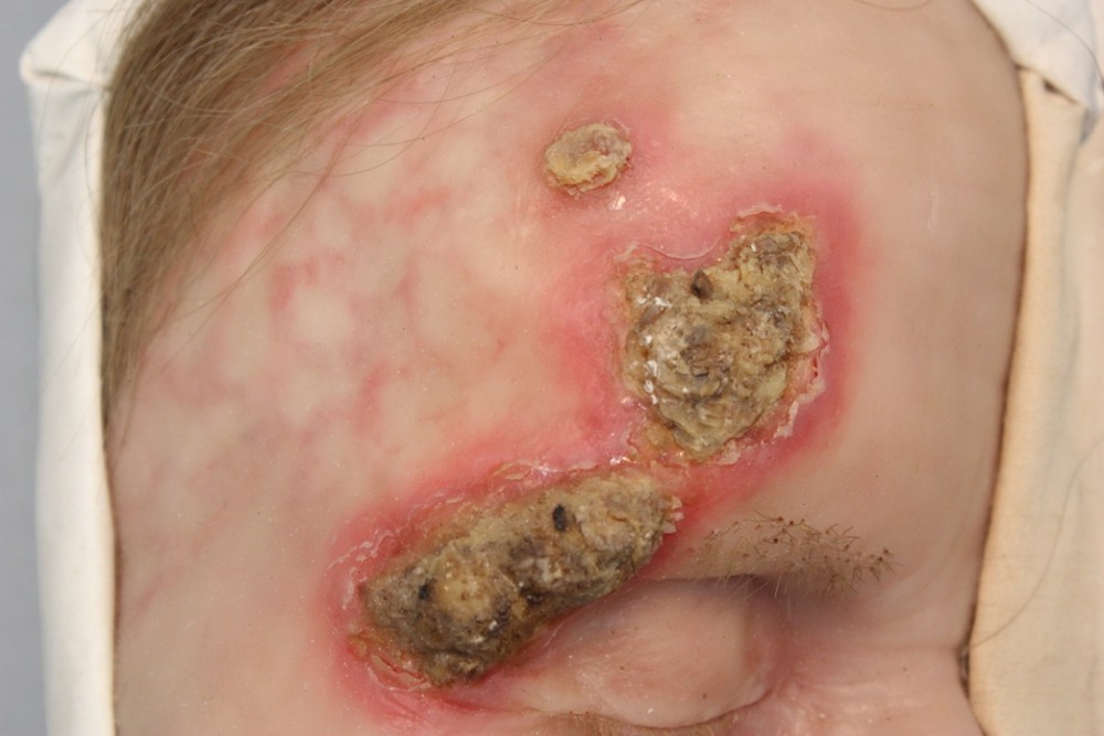 Как распознать первые симптомы сифилиса на ранних стадиях?