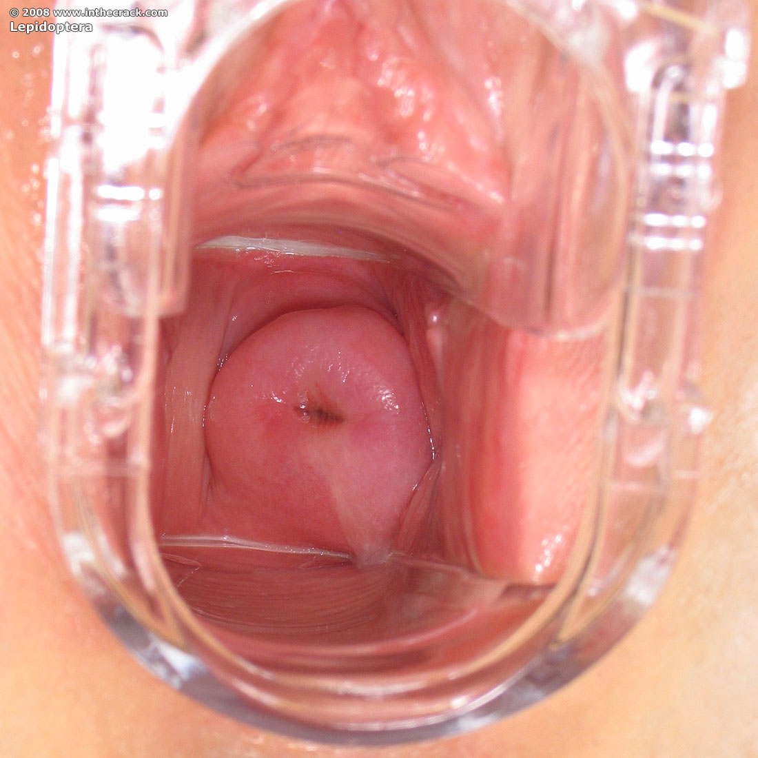 Женщина после родов: восстановление влагалища