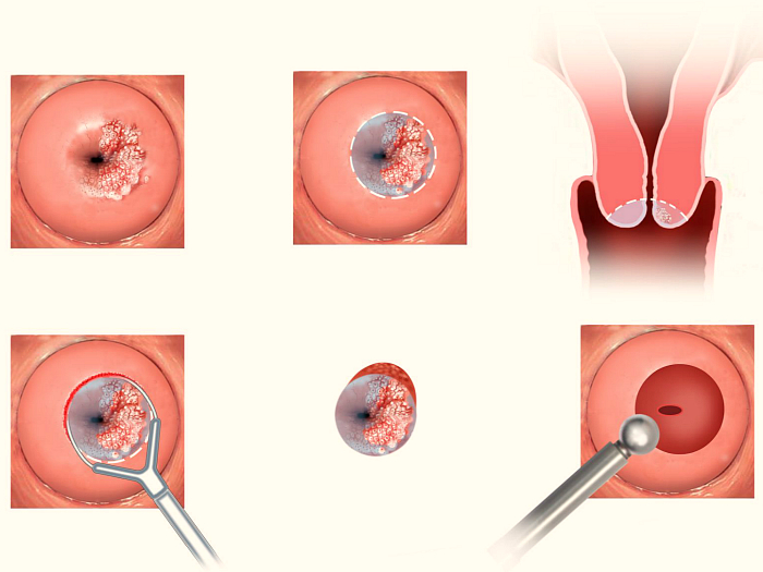Прижигание эрозии шейки матки: описание и последствия процедуры