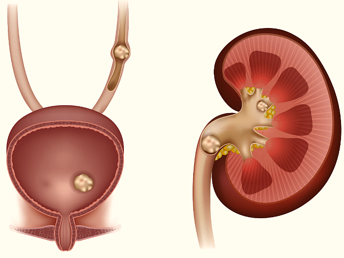 Основные клинические признаки и методы лечения камней в мочевом пузыре