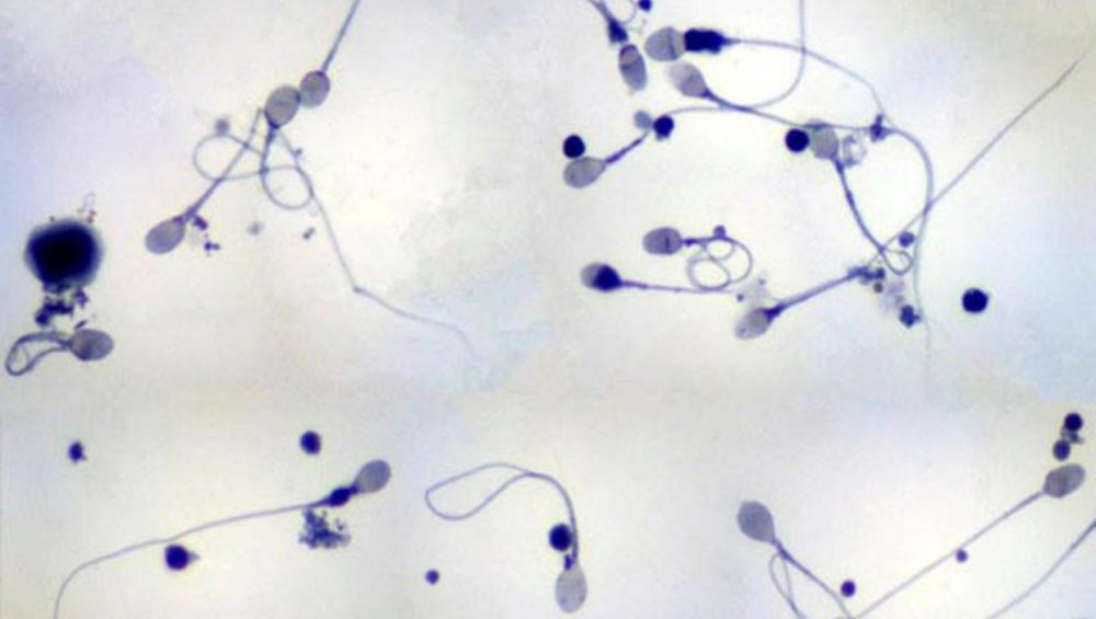 Агглютинация сперматозоидов: причины и описание патологии