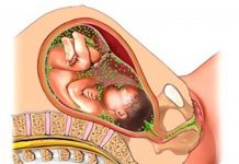 Хламидиоз при беременности: опасность, симптомы и лечение