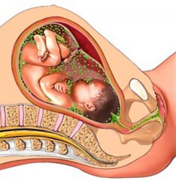 Хламидиоз при беременности: опасность, симптомы и лечение