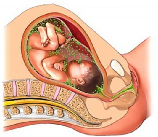Хламидиоз при беременности: опасность, симптомы и лечение