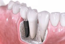 Особенности металлокерамических коронок