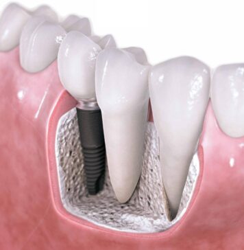 Особенности металлокерамических коронок