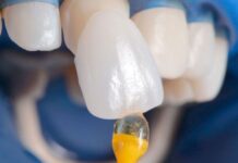 Установка винира: нюансы, риски, результат