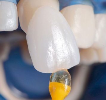 Установка винира: нюансы, риски, результат