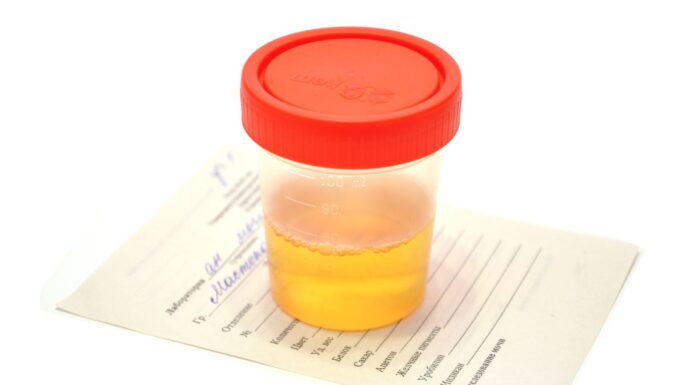 Диагностическая значимость анализа мочи