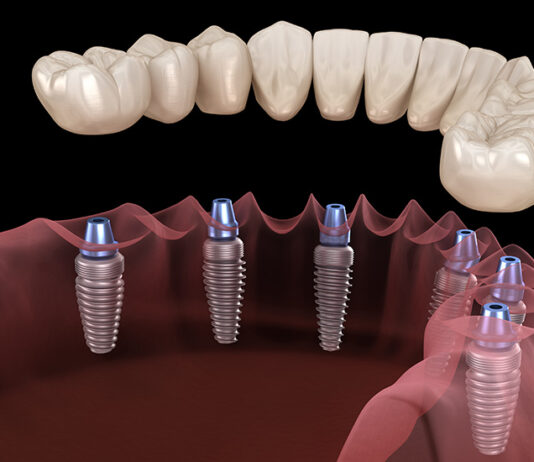 Имплантация зубов как альтернатива мостовидным и съемным протезам