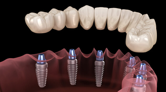 Имплантация зубов как альтернатива мостовидным и съемным протезам