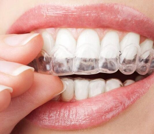 Съемные капы для выравнивания зубов