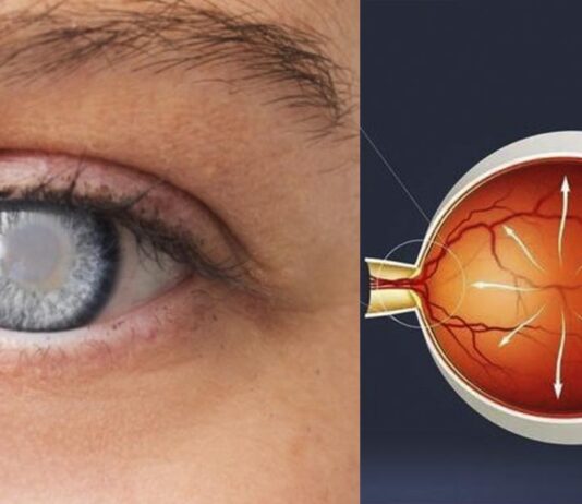 Причины развития глакуомы