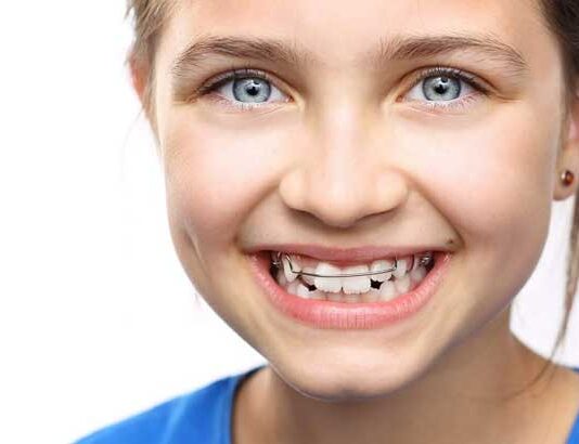Пластины на зубы: исправление детского прикусы