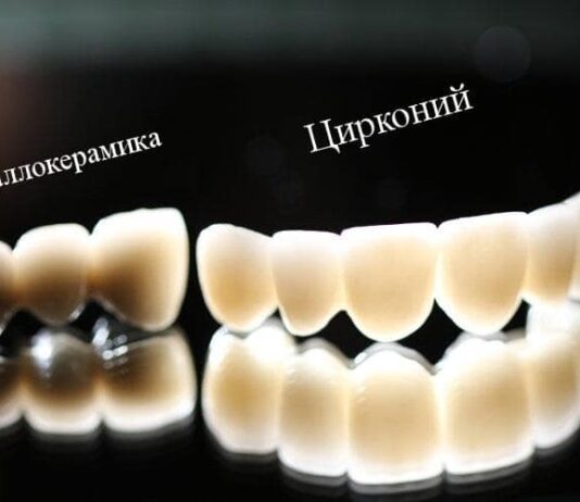 Циркониевые, металлокерамические коронки: какие выбрать?