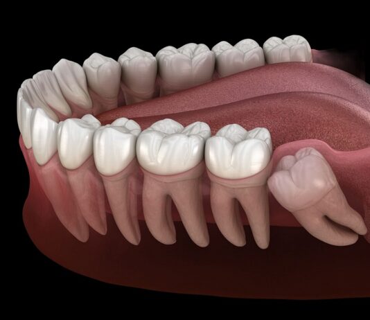 Зубы мудрости: для чего они нужны и можно ли их удалять?