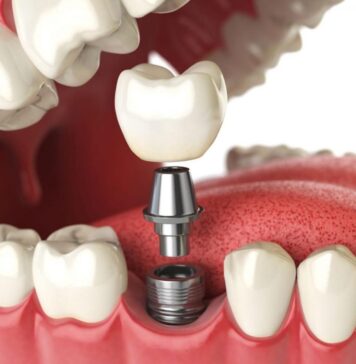 Имплантация зуба: показания, актуальные цены