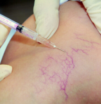 Склеротерапия вен: что за процедура и показания к ее проведению