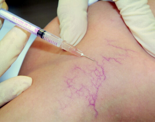 Склеротерапия вен: что за процедура и показания к ее проведению