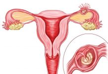 Причины внематочной беременности