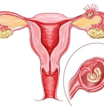 Причины внематочной беременности