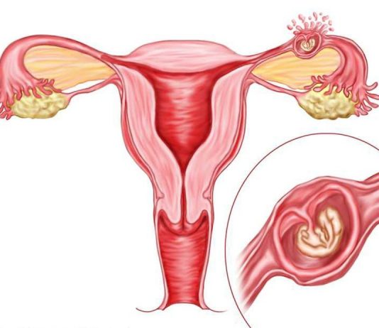 Причины внематочной беременности