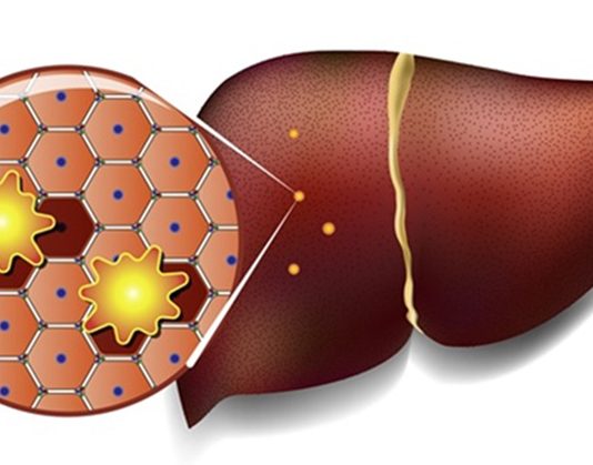 Стеатоз печени: симптомы и лечение