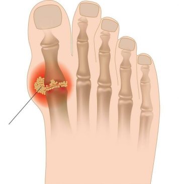 Острый приступ подагры: признаки, симптомы, лечение и первая помощь
