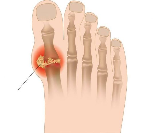 Острый приступ подагры: признаки, симптомы, лечение и первая помощь