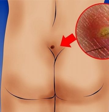 Лечение кисты копчика: причины появления, лечение