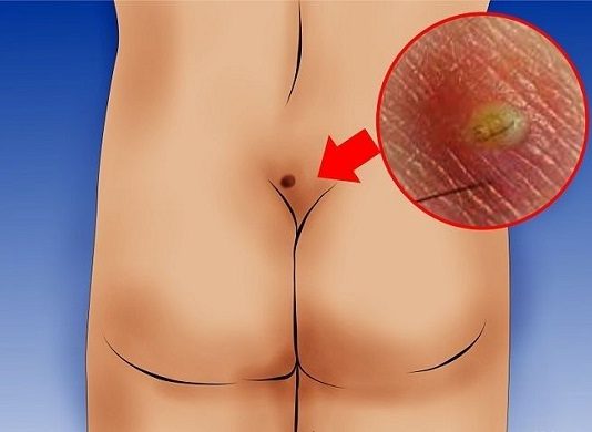 Лечение кисты копчика: причины появления, лечение