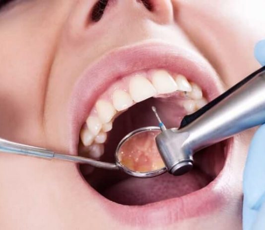 Что делать если у вас запущенная форма кариеса?