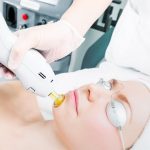 Преимущества лазерного лечения акне