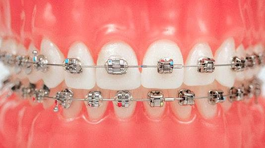 Показания для установки брекетов