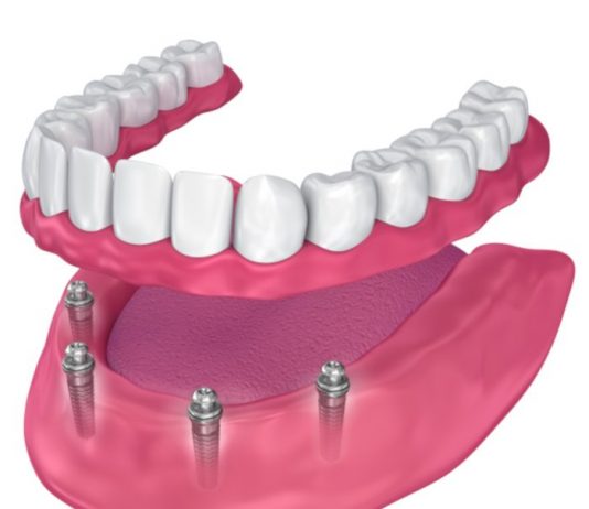 Что из себя представляет All on 4 имплантация?