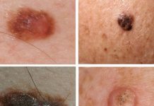 Каким способом лучше удалить Кератому?