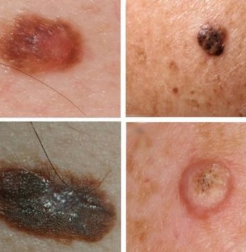 Каким способом лучше удалить Кератому?