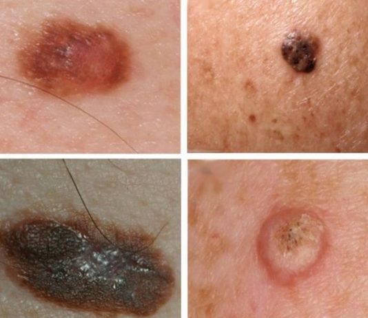 Каким способом лучше удалить Кератому?