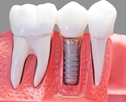 Правила имплантации зубов