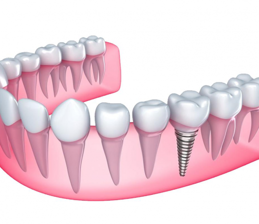 Имплантация зубов: особенности