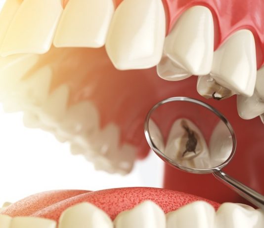 Профилактика и лечение кариеса