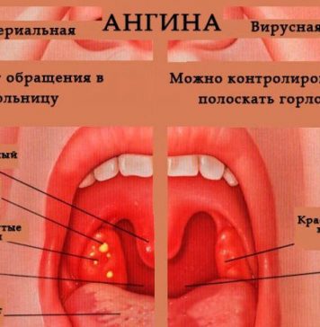 Частая ангина у детей: причины и способы лечения