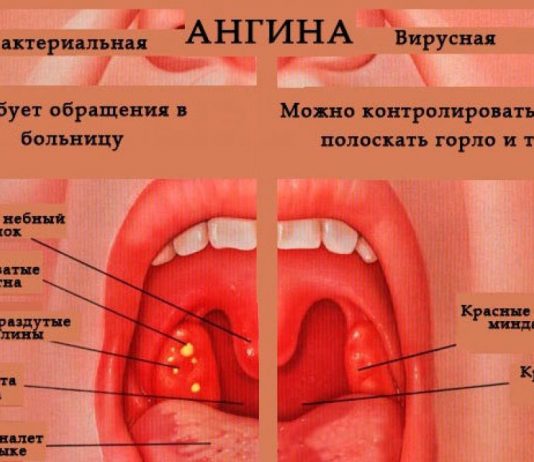Частая ангина у детей: причины и способы лечения