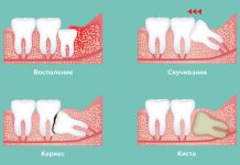 Поводы для удаления зуба мудрости