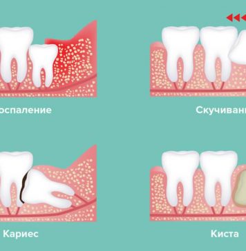 Поводы для удаления зуба мудрости