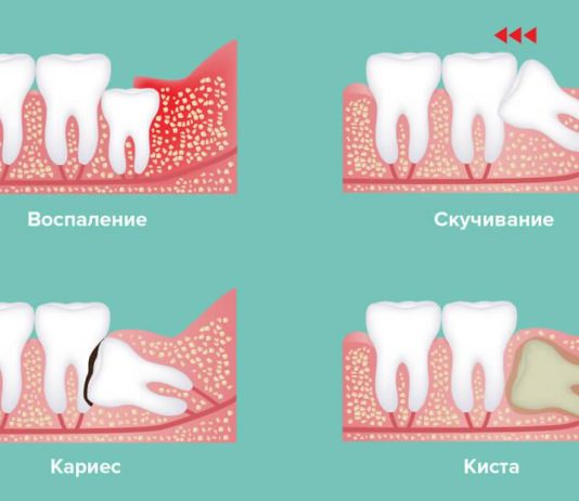 Поводы для удаления зуба мудрости