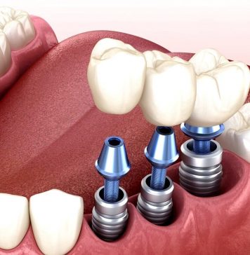 Имплантация зубов: виды и особенности