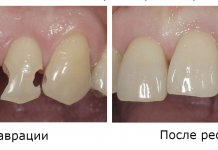 Реставрация зуба: что из себя представляет и когда проводится