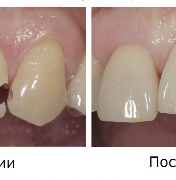 Реставрация зуба: что из себя представляет и когда проводится